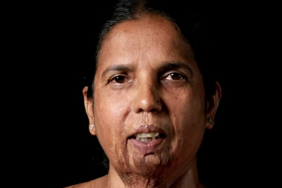 Creating jobs for acid-attack survivors with #SkillsNotScars